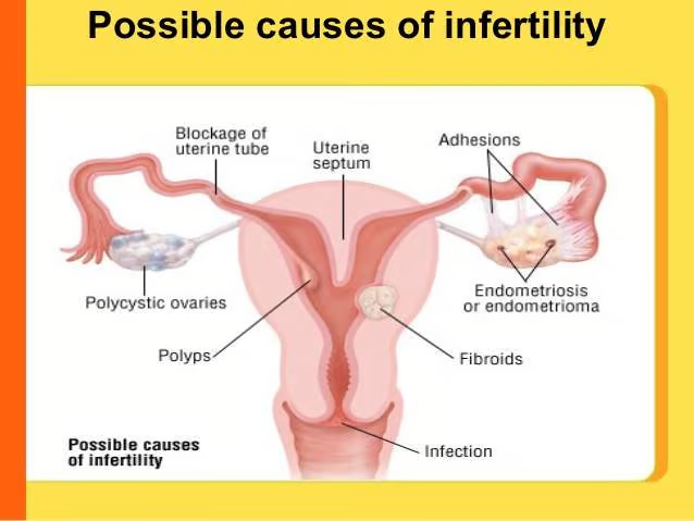 infertility